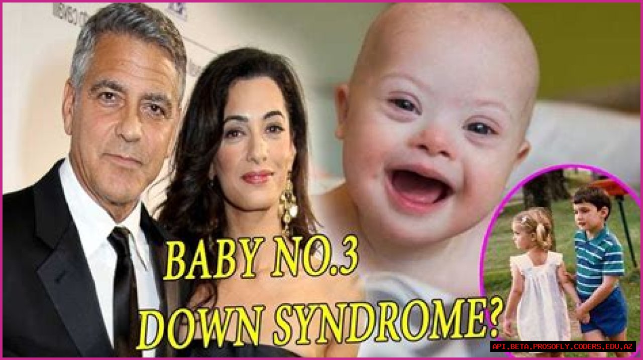 George Clooney's Son: Navigating Life With Down Syndrome